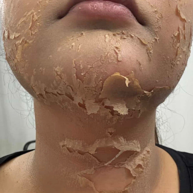 Close-up of a person's lower face and neck showing peeling beige skincare masks or sheets applied for 4 days, with text overlay reading 'Day 4 of full face & neck algae peel' and a social handle watermark at the bottom.