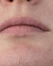 Close-up of a person's lower face showing dry, flaky skin on the chin and cheeks.