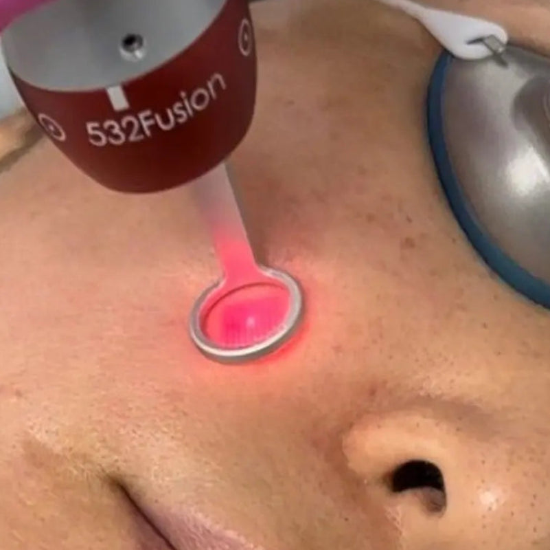 Close-up of a person receiving a facial treatment, with a handheld device emitting a pink light onto the cheek. The device is labeled '532Fusion', and protective glasses are worn over the eyes.
