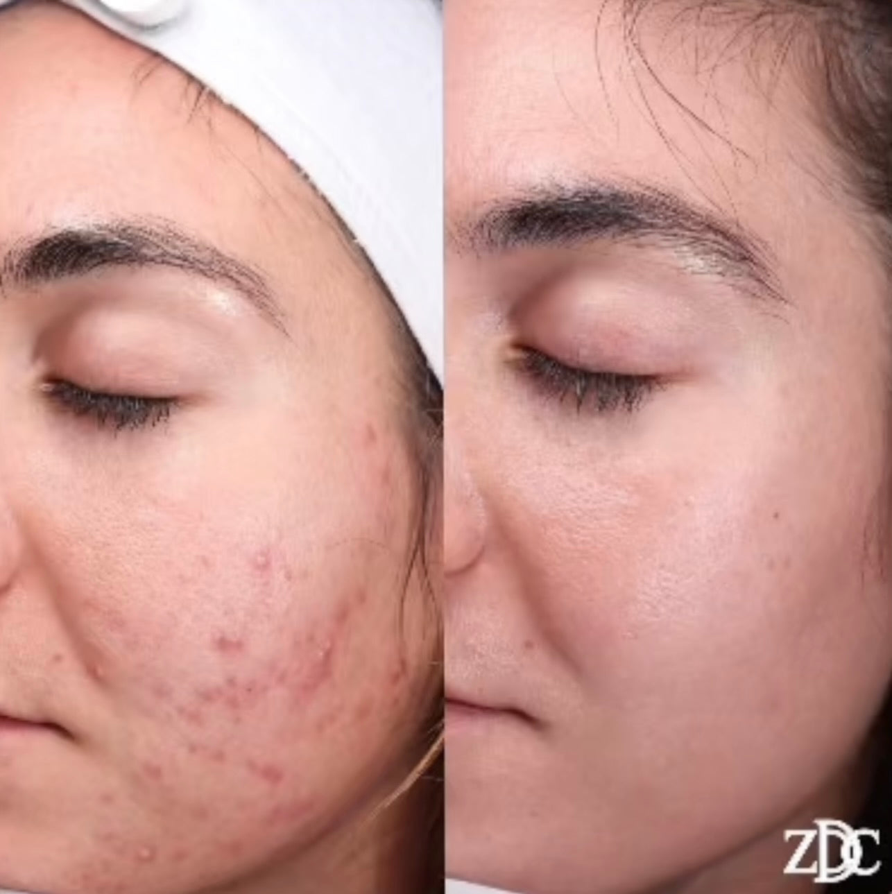 Before-and-after split screen comparison of a woman's face, showing active facial acne and redness on the left, and clearer, smoother skin on the right.