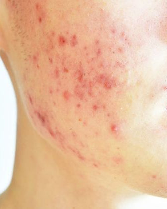 Close-up of a person's cheek and jawline showing severe acne blemishes and red inflamed pustules on light skin.