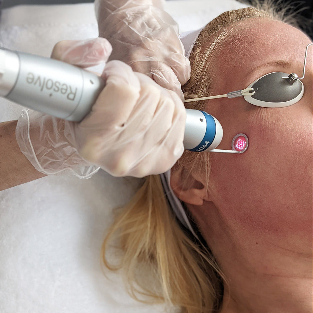 A close-up of a cosmetic treatment in progress, showing a person lying down with an eye shield and a small pink circular mark on their cheek while a gloved hand holds a silver Resolve device near the face.