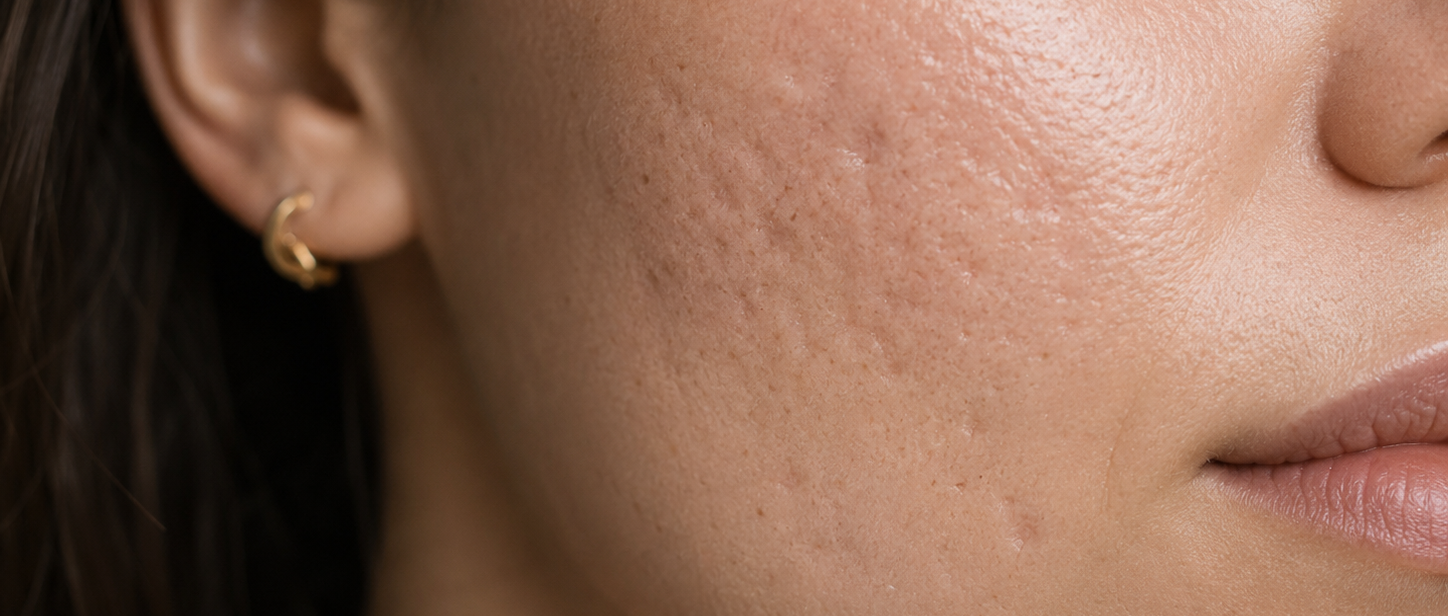 Close-up of a woman's face showing textured skin on her cheek, with her ear and a small gold hoop earring visible.