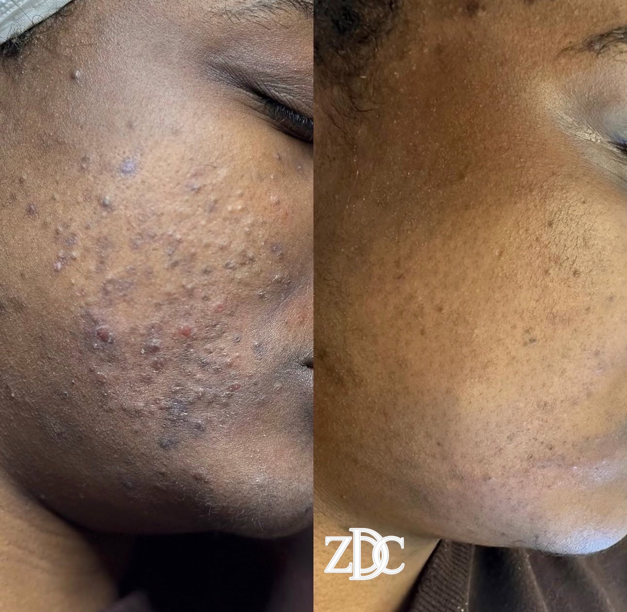Skin Before & After Gallery | Zina Derma Care