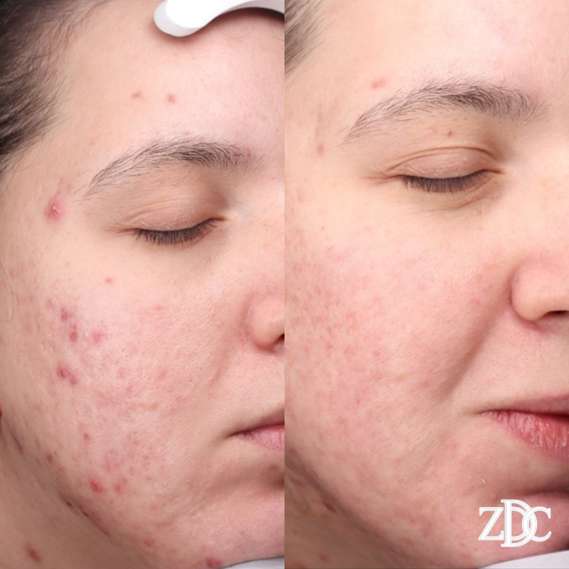 Skin Before & After Gallery | Zina Derma Care