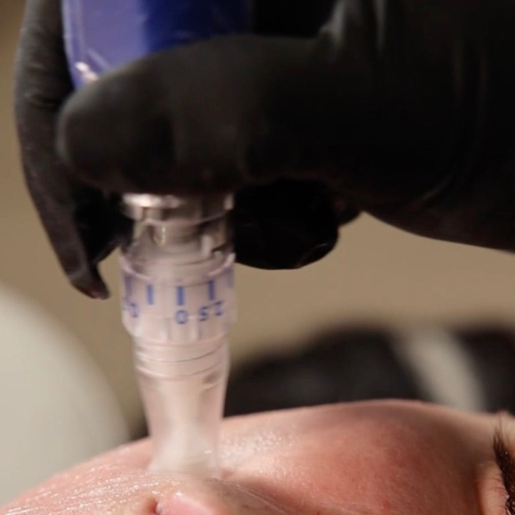 A close-up of a skincare or cosmetic treatment in progress, showing a gloved hand holding a blue and silver device against a person's face near the mouth.